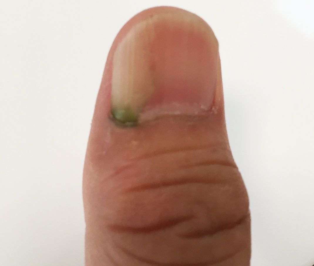 爪の根元に緑膿菌